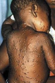 Monkeypox: Bayelsa Intensifies Sensitisation Campaign