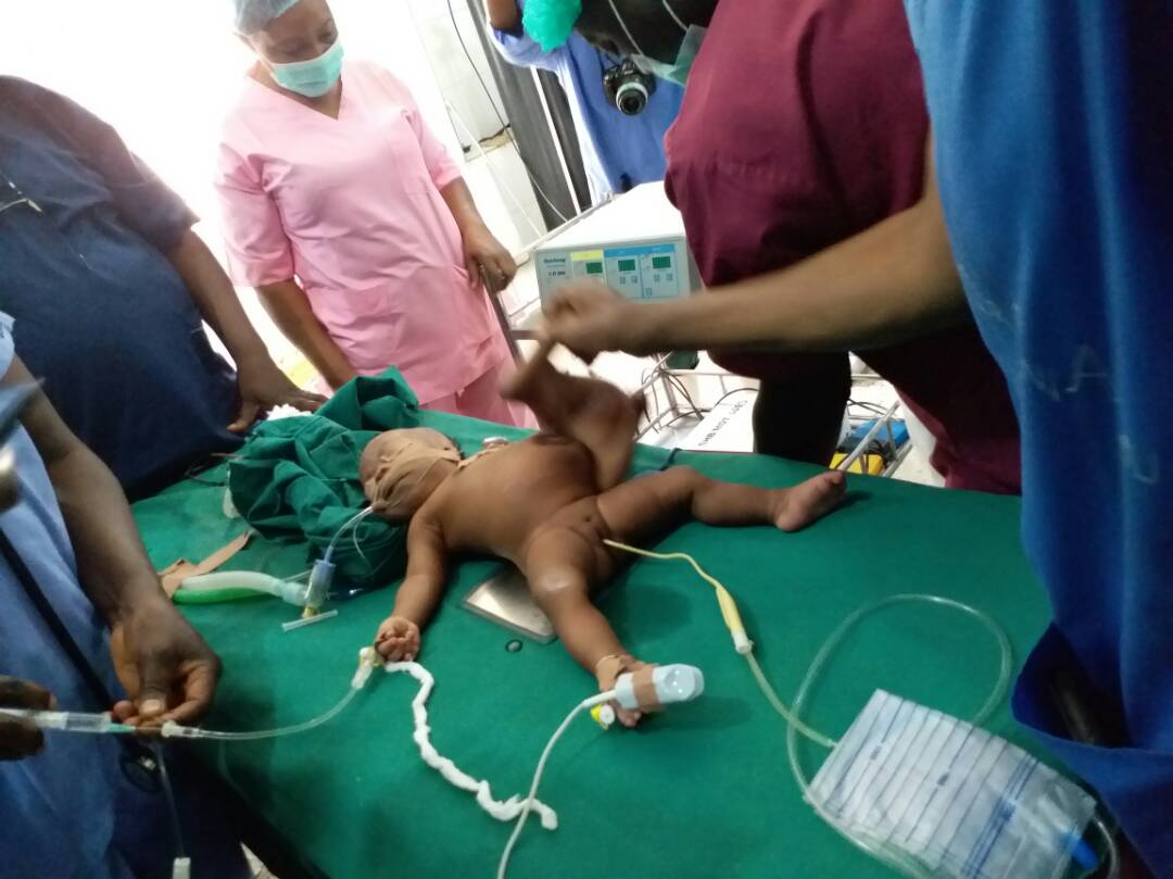 50,000 Benefits from Speaker Dogara’s Free Medical Outreach, Conjoined Twins Separated